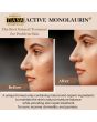 TIANA Active Monolaurin for Acne, Eczema, Dermatitis and Psoriasis